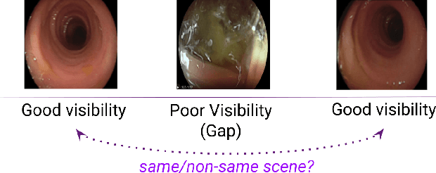Figure 1 for Colonoscopy Coverage Revisited: Identifying Scanning Gaps in Real-Time