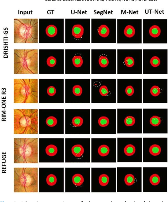 Figure 4 for UT-Net: Combining U-Net and Transformer for Joint Optic Disc and Cup Segmentation and Glaucoma Detection