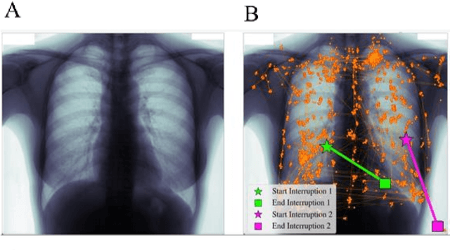 Figure 1 for Incorporation of Eye-Tracking and Gaze Feedback to Characterize and Improve Radiologist Search Patterns of Chest X-rays: A Randomized Controlled Clinical Trial