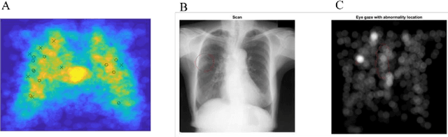 Figure 4 for Incorporation of Eye-Tracking and Gaze Feedback to Characterize and Improve Radiologist Search Patterns of Chest X-rays: A Randomized Controlled Clinical Trial