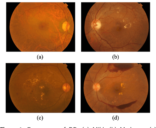 Figure 1 for Dual Branch Deep Learning Network for Detection and Stage Grading of Diabetic Retinopathy