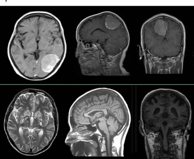 Figure 1 for Neural Gas Network Image Features and Segmentation for Brain Tumor Detection Using Magnetic Resonance Imaging Data