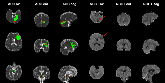 Figure 1 for APIS: A paired CT-MRI dataset for ischemic stroke segmentation challenge