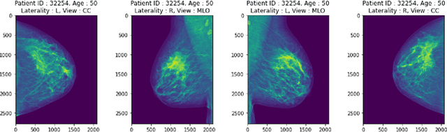 Figure 2 for Screening Mammography Breast Cancer Detection