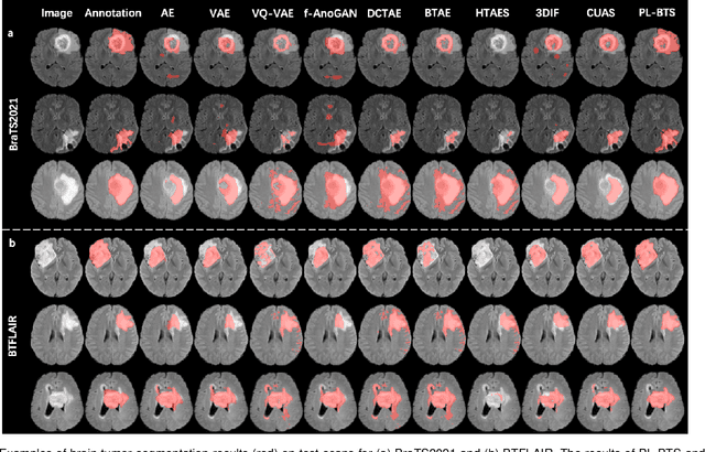 Figure 4 for Unsupervised Brain Tumor Segmentation with Image-based Prompts