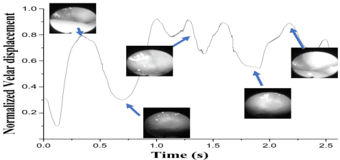 Figure 3 for Speaker-independent Speech Inversion for Estimation of Nasalance