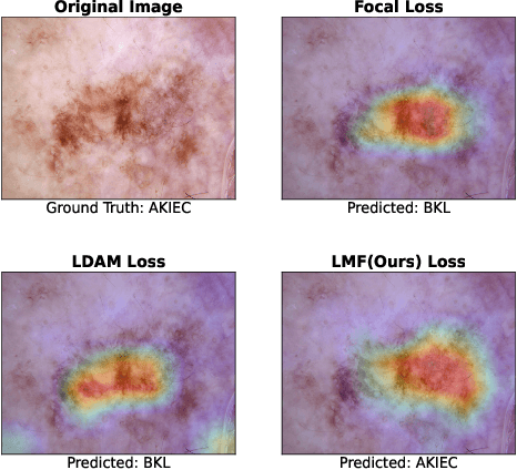 Figure 3 for LMFLOSS: A Hybrid Loss For Imbalanced Medical Image Classification