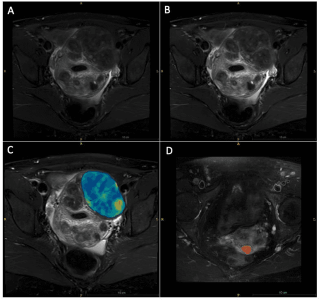 Figure 2 for Developing a Machine Learning-Based Clinical Decision Support Tool for Uterine Tumor Imaging