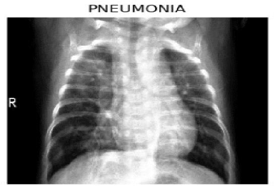 Figure 2 for Advancing Diagnostic Precision: Leveraging Machine Learning Techniques for Accurate Detection of Covid-19, Pneumonia, and Tuberculosis in Chest X-Ray Images