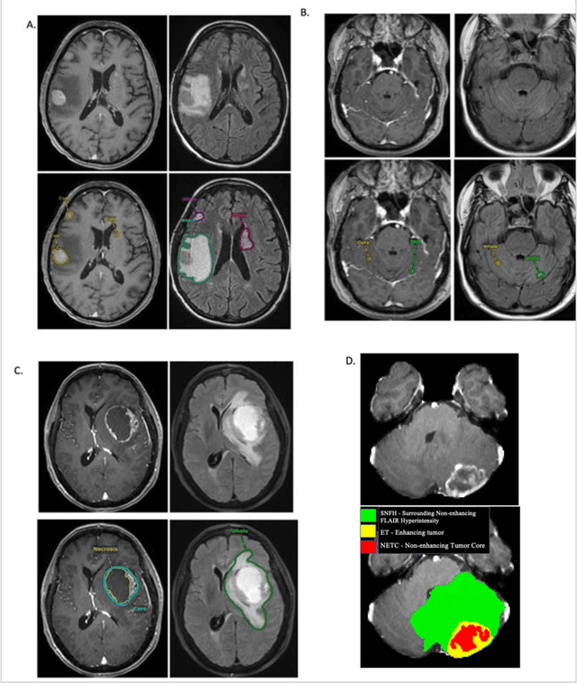 Figure 3 for The Brain Tumor Segmentation (BraTS-METS) Challenge 2023: Brain Metastasis Segmentation on Pre-treatment MRI
