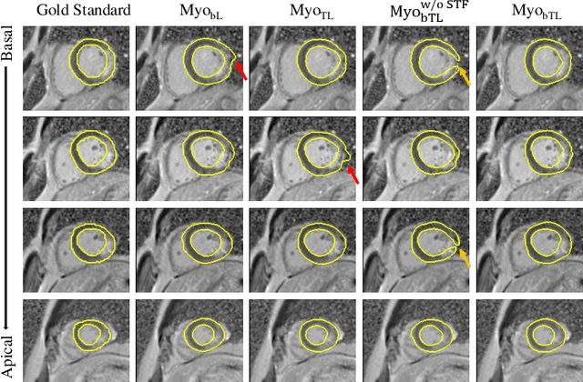 Figure 4 for Aligning Multi-Sequence CMR Towards Fully Automated Myocardial Pathology Segmentation