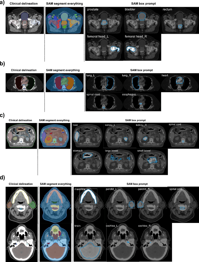 Figure 1 for Segment Anything Model (SAM) for Radiation Oncology