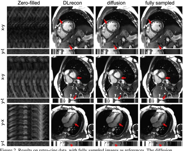 Figure 2 for Clinically Feasible Diffusion Reconstruction for Highly-Accelerated Cardiac Cine MRI