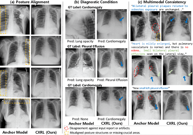 Figure 3 for Advancing Text-Driven Chest X-Ray Generation with Policy-Based Reinforcement Learning