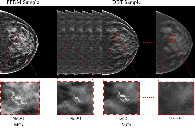 Figure 1 for MLN-net: A multi-source medical image segmentation method for clustered microcalcifications using multiple layer normalization