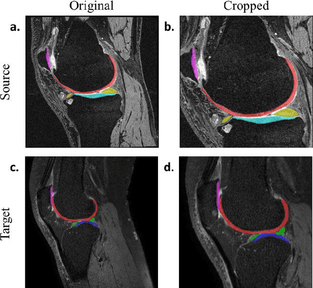 Figure 4 for Unsupervised Domain Adaptation for Automated Knee Osteoarthritis Phenotype Classification