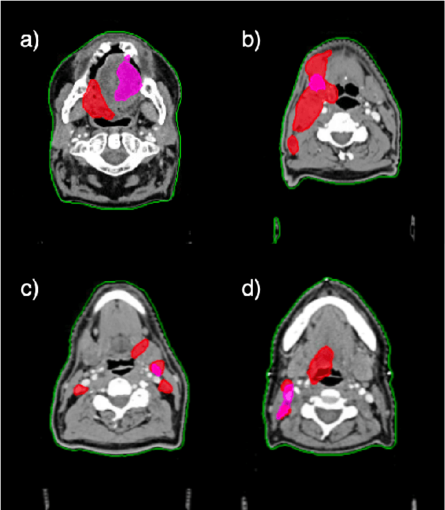 Figure 3 for Prediction of post-radiotherapy recurrence volumes in head and neck squamous cell carcinoma using 3D U-Net segmentation