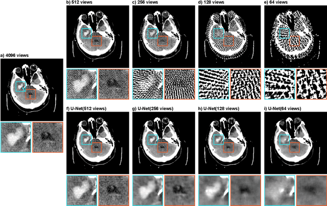 Figure 4 for Improving Automated Hemorrhage Detection in Sparse-view Computed Tomography via Deep Convolutional Neural Network based Artifact Reduction