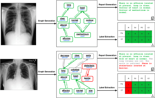 Figure 3 for Prior-RadGraphFormer: A Prior-Knowledge-Enhanced Transformer for Generating Radiology Graphs from X-Rays