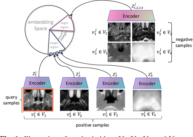 Figure 1 for Multi-view Contrastive Learning with Additive Margin for Adaptive Nasopharyngeal Carcinoma Radiotherapy Prediction