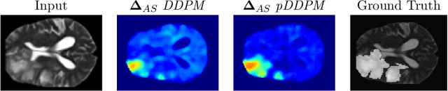 Figure 3 for Patched Diffusion Models for Unsupervised Anomaly Detection in Brain MRI