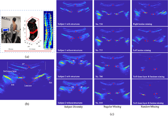 Figure 1 for VertMatch: A Semi-supervised Framework for Vertebral Structure Detection in 3D Ultrasound Volume