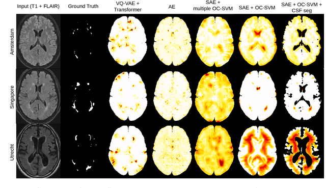 Figure 3 for One-Class SVM on siamese neural network latent space for Unsupervised Anomaly Detection on brain MRI White Matter Hyperintensities