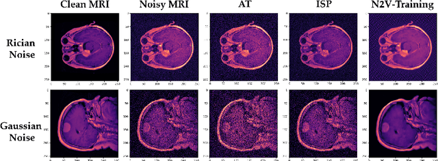Figure 3 for Robust Influence-based Training Methods for Noisy Brain MRI