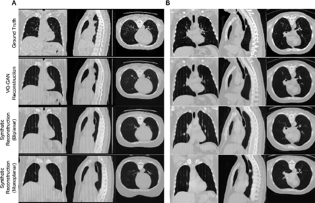 Figure 4 for Transformers for CT Reconstruction From Monoplanar and Biplanar Radiographs