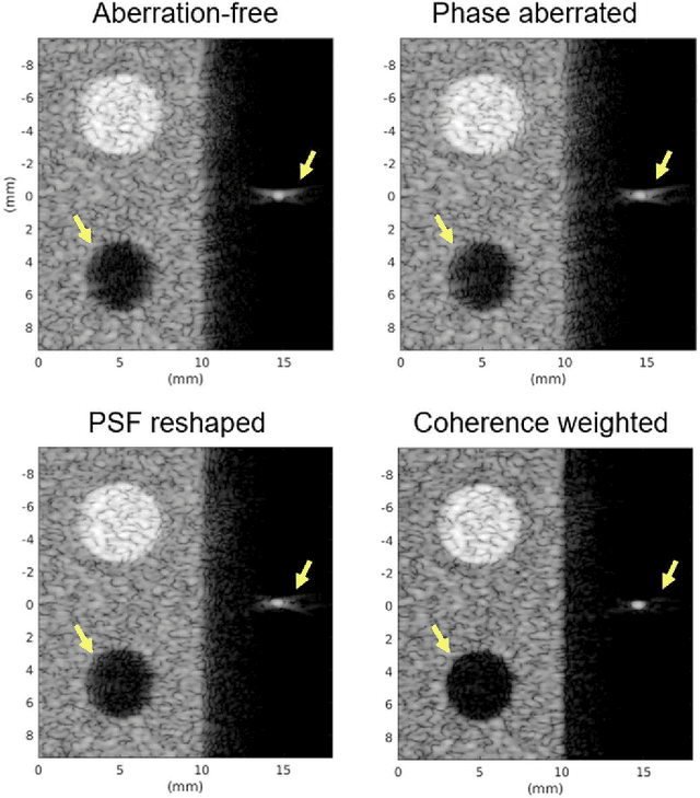 Figure 2 for Phase Aberration Correction with Adaptive Coherence-Weighted Point Spread Function Restoration Filtering Technique