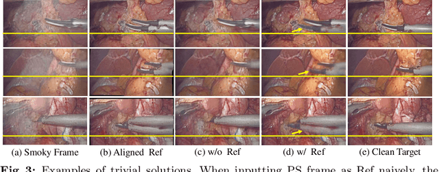 Figure 4 for Self-Supervised Video Desmoking for Laparoscopic Surgery