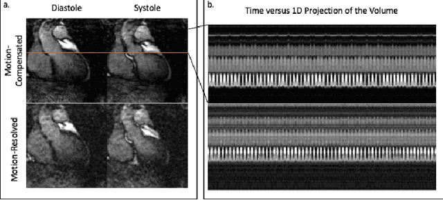 Figure 3 for Motion Compensated Unsupervised Deep Learning for 5D MRI