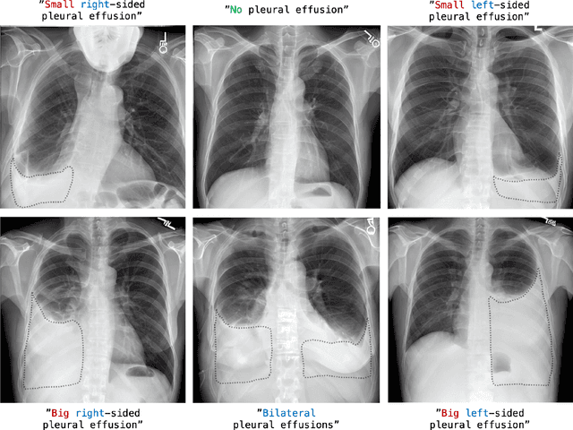 Figure 3 for RoentGen: Vision-Language Foundation Model for Chest X-ray Generation