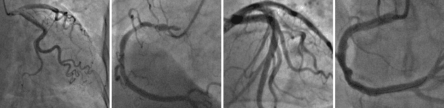 Figure 1 for LightVessel: Exploring Lightweight Coronary Artery Vessel Segmentation via Similarity Knowledge Distillation