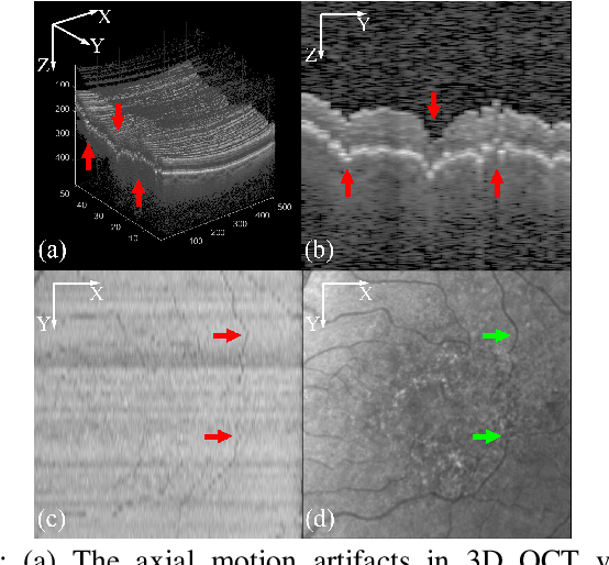 Figure 1 for Deep learning network to correct axial and coronal eye motion in 3D OCT retinal imaging