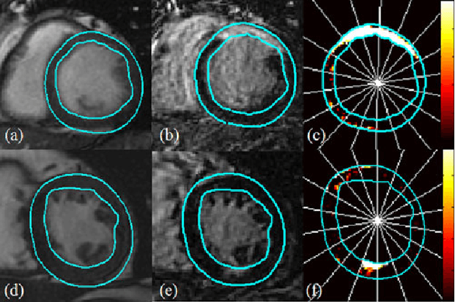 Figure 3 for Methodology for Jointly Assessing Myocardial Infarct Extent and Regional Contraction in 3-D CMRI