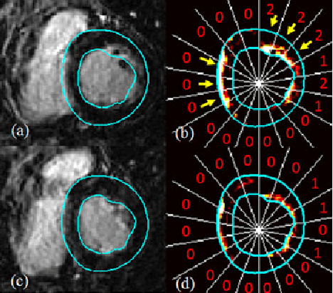 Figure 4 for Methodology for Jointly Assessing Myocardial Infarct Extent and Regional Contraction in 3-D CMRI