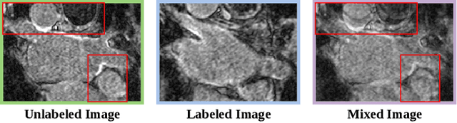 Figure 2 for Dual-Decoder Consistency via Pseudo-Labels Guided Data Augmentation for Semi-Supervised Medical Image Segmentation