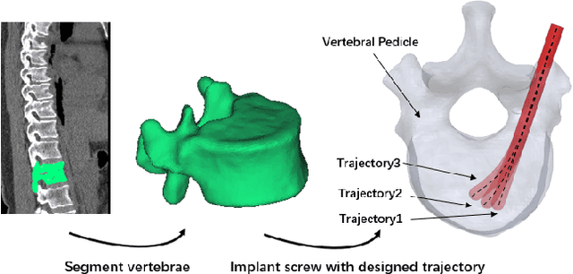 Figure 1 for Towards Biomechanics-Aware Design of a Steerable Drilling Robot for Spinal Fixation Procedures with Flexible Pedicle Screws