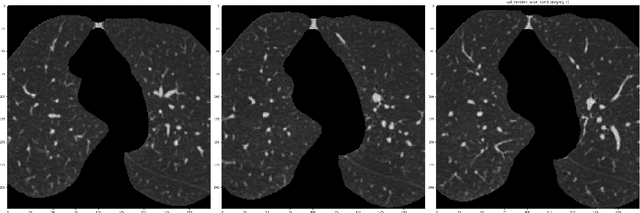 Figure 2 for Severity classification of ground-glass opacity via 2-D convolutional neural network and lung CT scans: a 3-day exploration