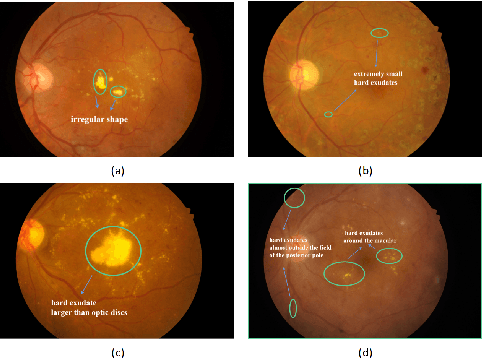 Figure 1 for Hard Exudate Segmentation Supplemented by Super-Resolution with Multi-scale Attention Fusion Module