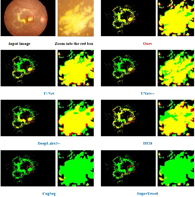 Figure 4 for Hard Exudate Segmentation Supplemented by Super-Resolution with Multi-scale Attention Fusion Module
