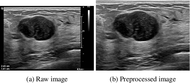 Figure 4 for Performance of Machine Learning Classification in Mammography Images using BI-RADS