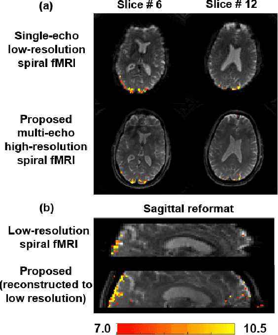 Figure 3 for Non-Cartesian Self-Supervised Physics-Driven Deep Learning Reconstruction for Highly-Accelerated Multi-Echo Spiral fMRI
