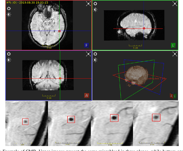 Figure 3 for Review of methods for automatic cerebral microbleeds detection