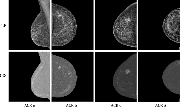 Figure 2 for A Deep Learning Approach for Virtual Contrast Enhancement in Contrast Enhanced Spectral Mammography