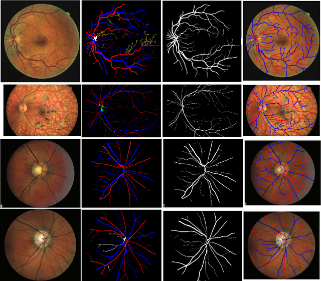 Figure 1 for Fully Automated Artery-Vein ratio and vascular tortuosity measurement in retinal fundus images