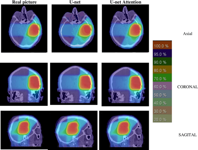 Figure 4 for Attention U-net approach in predicting Intensity Modulated Radiation Therapy dose distribution in brain glioma tumor
