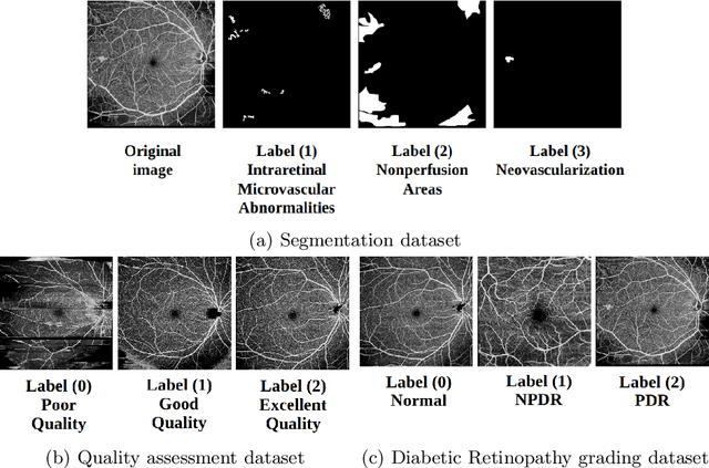 Figure 2 for Segmentation, Classification, and Quality Assessment of UW-OCTA Images for the Diagnosis of Diabetic Retinopathy