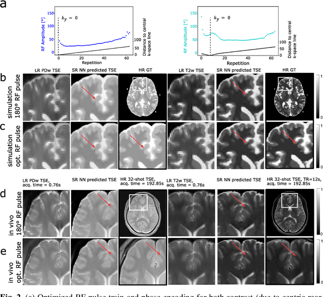 Figure 3 for Joint MR sequence optimization beats pure neural network approaches for spin-echo MRI super-resolution